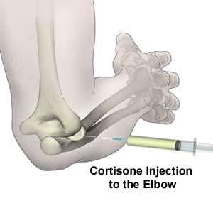 cortisone_injection.jpg